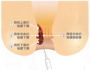 ジオン注について