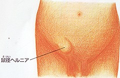 鼠径ヘルニア(脱腸)とは